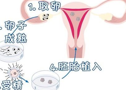 2026在潍坊市罗氏易位能做三代试管婴儿生子吗，相互易位和罗氏易位有什么区别？